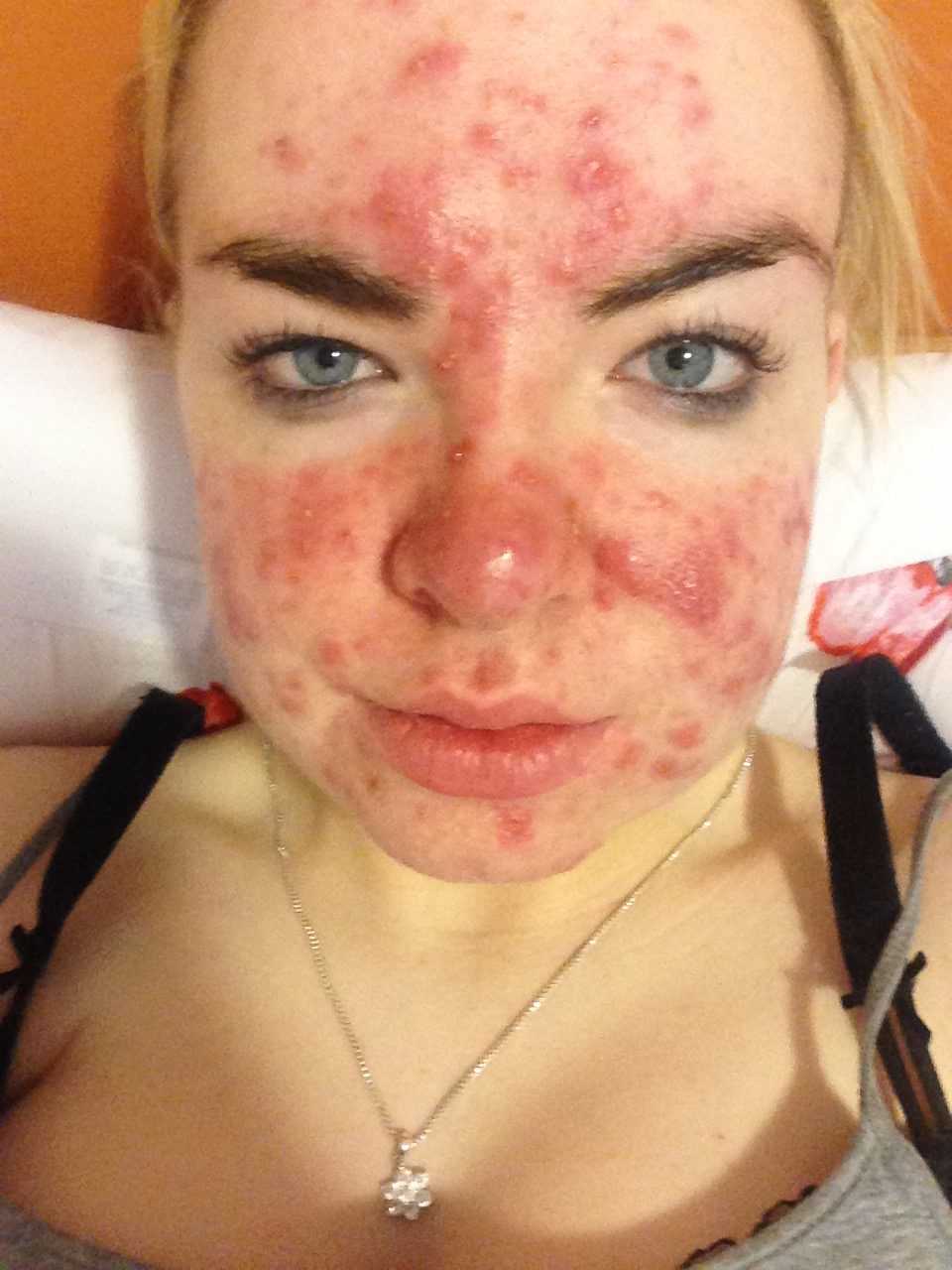 Update on my story with Acne!