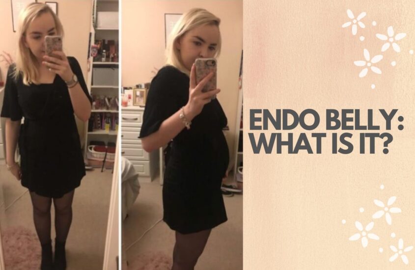 endo belly bloating